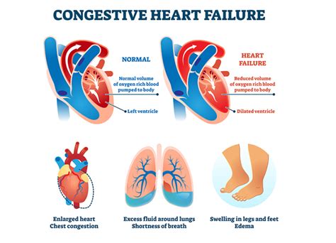 Congestive Heart Failure .